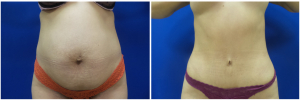 JR-abdominoplasty-before-after-photo-1-1