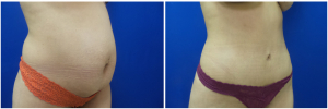 JR-abdominoplasty-before-after-photo-1-2