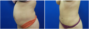 JR-abdominoplasty-before-after-photo-1-3