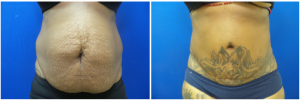 KK-abdominoplasty-before-after-photo-1-1