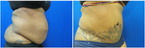 KK-abdominoplasty-before-after-photo-1-2