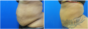 KK-abdominoplasty-before-after-photo-1-3