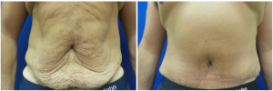 MV-abdominoplasty-before-after-photo-1-1