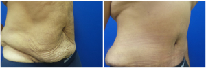MV-abdominoplasty-before-after-photo-1-2
