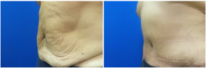 MV-abdominoplasty-before-after-photo-1-3