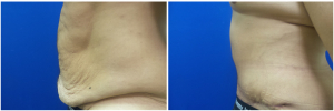 MV-abdominoplasty-before-after-photo-1-4