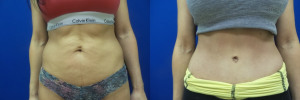 RV-abdominoplasty-before-after-photo-1-1