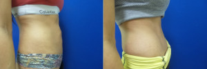 RV-abdominoplasty-before-after-photo-1-2