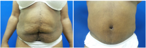 WJ-abdominoplasty-before-after-photo-1-1