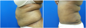 WJ-abdominoplasty-before-after-photo-1-2