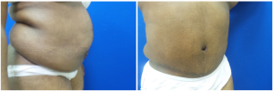 WJ-abdominoplasty-before-after-photo-1-3
