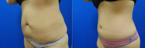abdominoplasty-before-after-photo-12-2