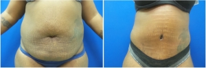 abdominoplasty-before-after-photo-3-1