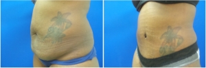 abdominoplasty-before-after-photo-3-2