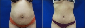abdominoplasty-before-after-photo-4-1