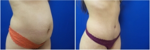 abdominoplasty-before-after-photo-4-2