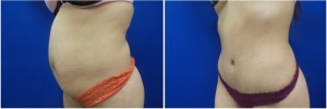 abdominoplasty-before-after-photo-4-3
