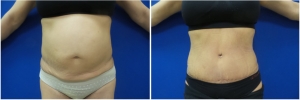 abdominoplasty-before-after-photo-5-1