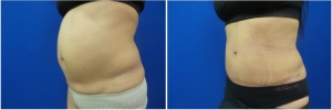 abdominoplasty-before-after-photo-5-2