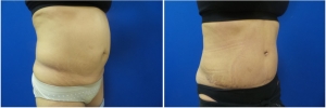 abdominoplasty-before-after-photo-5-3