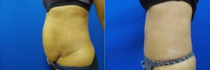 abdominoplasty-before-after-photo-7-2