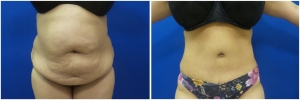 abdominoplasty-tummy-tuck-before-after-1-1