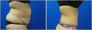 abdominoplasty-tummy-tuck-before-after-1-2