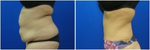 abdominoplasty-tummy-tuck-before-after-1-3