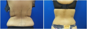 abdominoplasty-tummy-tuck-before-after-1-4