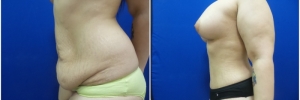 abdominoplasty1-2