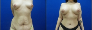 abdominoplasty1-3