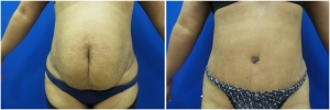 liposuction-abdominoplasty-before-after-photo-16-1