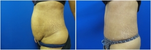 liposuction-abdominoplasty-before-after-photo-16-2