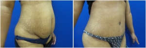 liposuction-abdominoplasty-before-after-photo-16-3