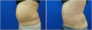 liposuction-abdominoplasty-before-after-photo-20-4