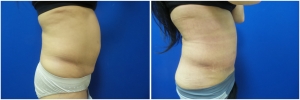 liposuction-abdominoplasty-before-after-photo-20-5