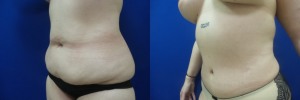 liposuction-abdominoplasty-before-after-photo-21-1