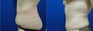 liposuction-abdominoplasty-before-after-photo-21-2