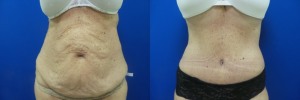 liposuction-abdominoplasty-before-after-photo-23-1