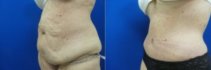 liposuction-abdominoplasty-before-after-photo-23-2