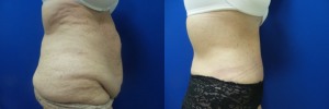 liposuction-abdominoplasty-before-after-photo-23-3