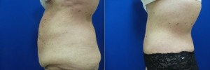liposuction-abdominoplasty-before-after-photo-23-4
