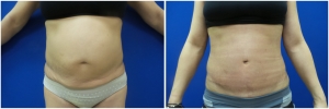 liposuction-abdominoplastybefore-after-photo-20-1