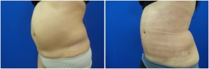 liposuction-abdominoplastybefore-after-photo-20-2