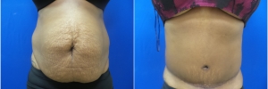 tummy-tuck-1-1