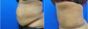 tummy-tuck-1-2