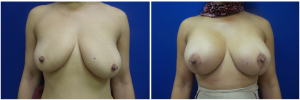 AH-breast-implants-augmentation-mastopexy-revision-before-after-1-1