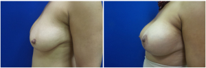 AH-breast-implants-augmentation-mastopexy-revision-before-after-1-2