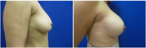 AH-breast-implants-augmentation-mastopexy-revision-before-after-1-3