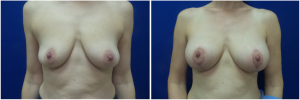 IP-breast-lift-mastopexy-revision-before-after-1-1